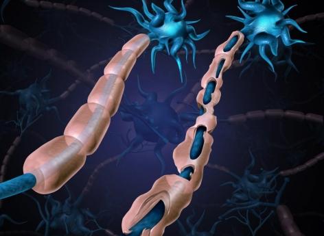 Sclérose en plaques : une nouvelle cible contre l'atteinte de la myéline