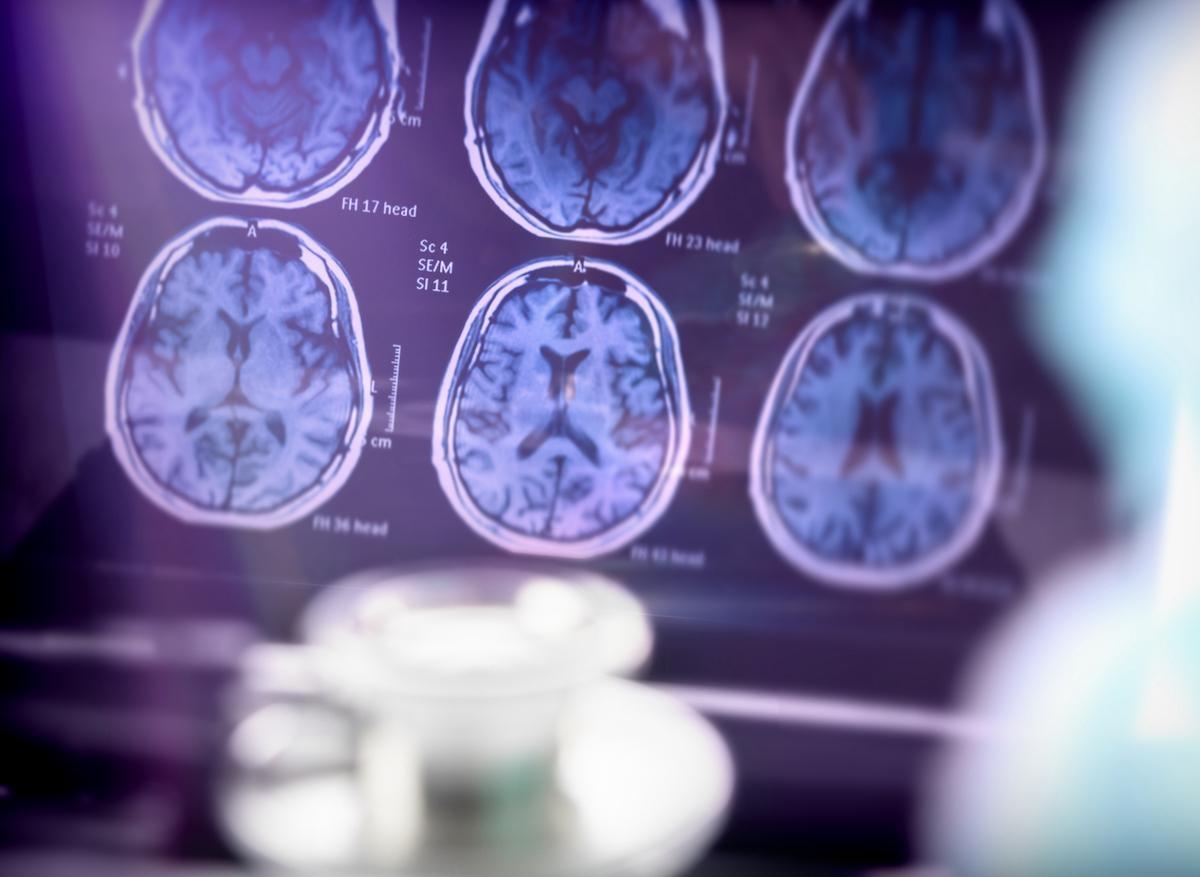 Alzheimer : la neuroimagerie fonctionnelle serait modifiée de façon précoce