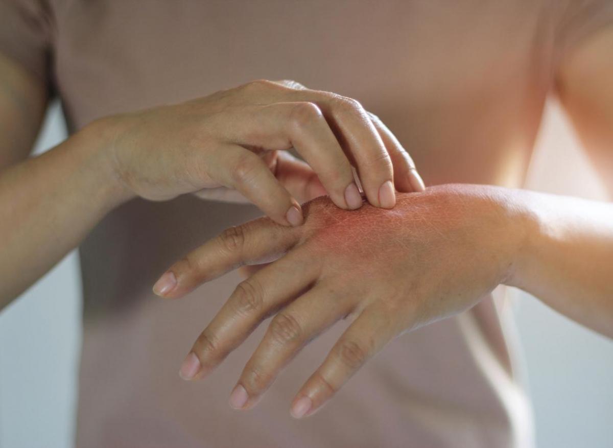 Dermatite allergique de contact : certains patients sont plus sensibles que d’autres