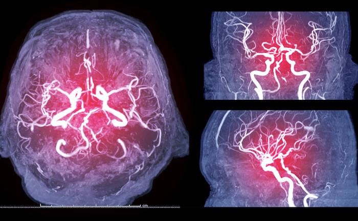 AVC ischémique : rôle d’une l’infection et de l’inflammation chronique dans la majorité des cas