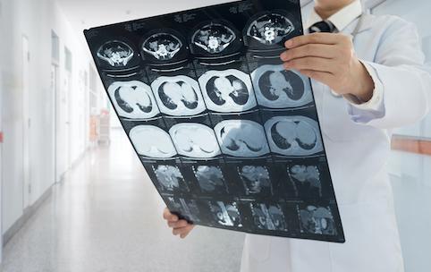 Cancer du poumon : plus de doute sur l'intérêt du scanner dans le dépistage des patients à risque