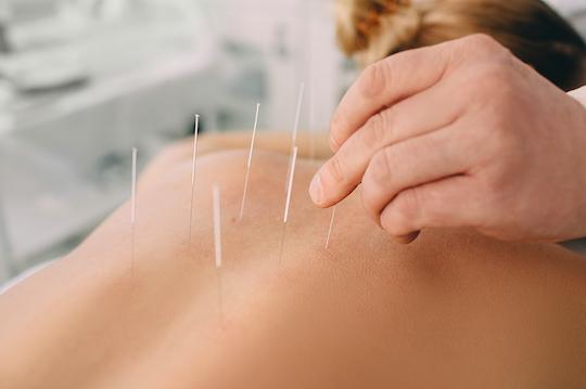 Lombalgie chronique : l’acupuncture aurait une efficacité culture-dépendante 