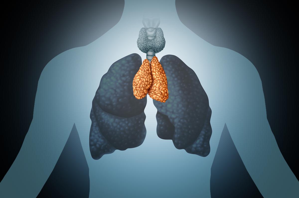 Carcinome thymique avancé : des longs répondeurs sous pembrolizumab 