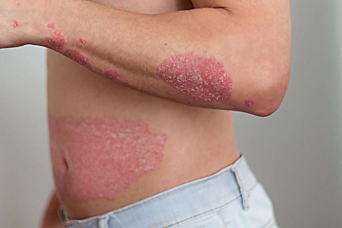 Psoriasis cutané : possible supériorité du blocage combiné IL-17A et IL-17F