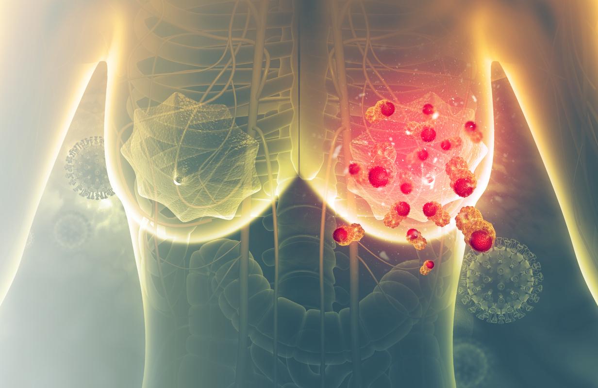 Cancer du sein métastatique : sels de platine & inhibiteur de PARP