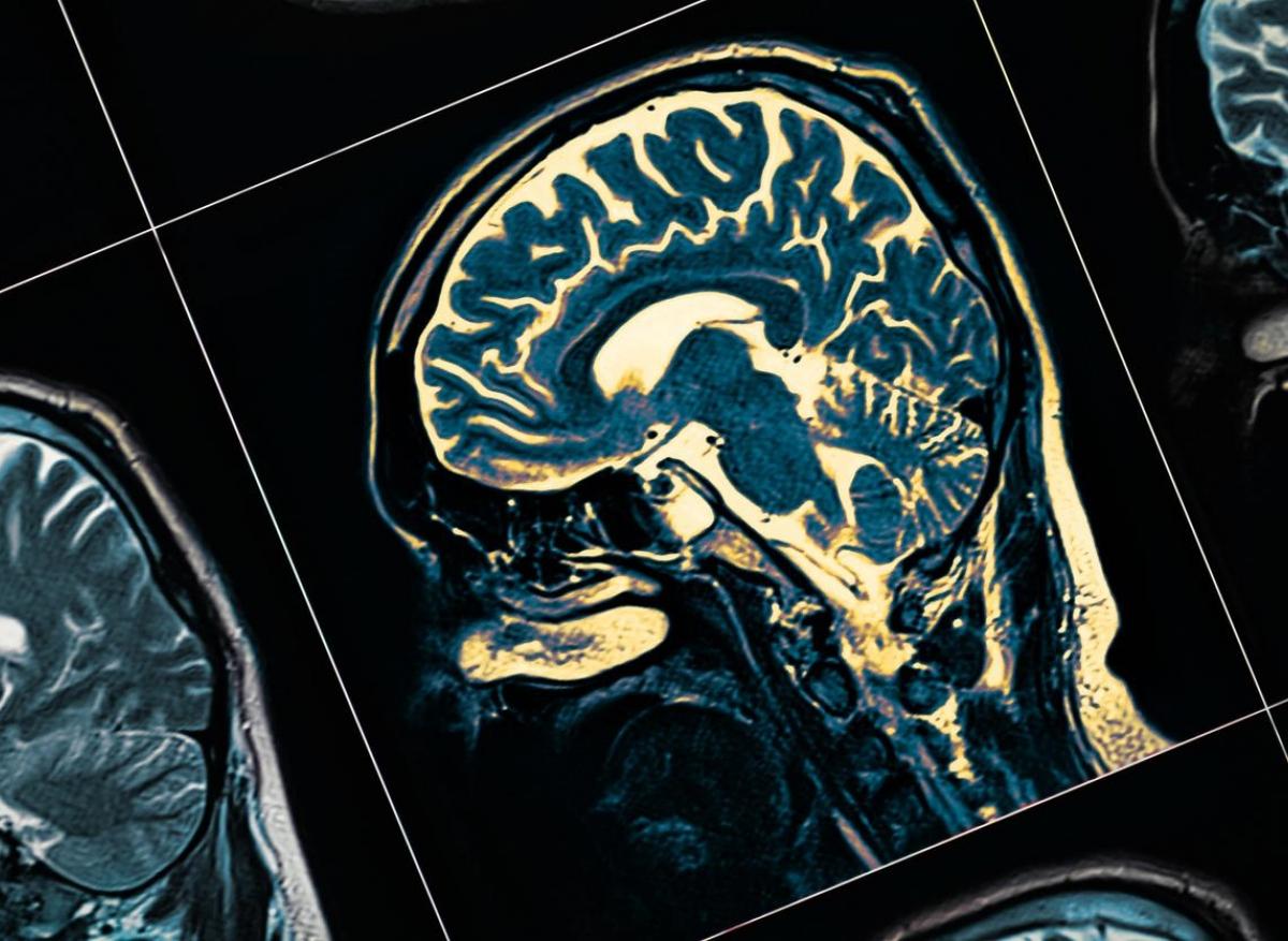 Schizophrénie : PCDHA3, un gène muté fortement impliqué