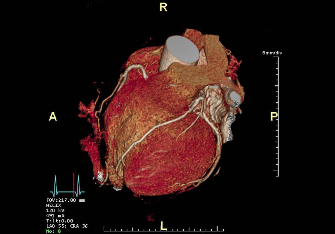 Douleur thoracique stable : le coroscanner diagnostique aussi bien que l’angiographie