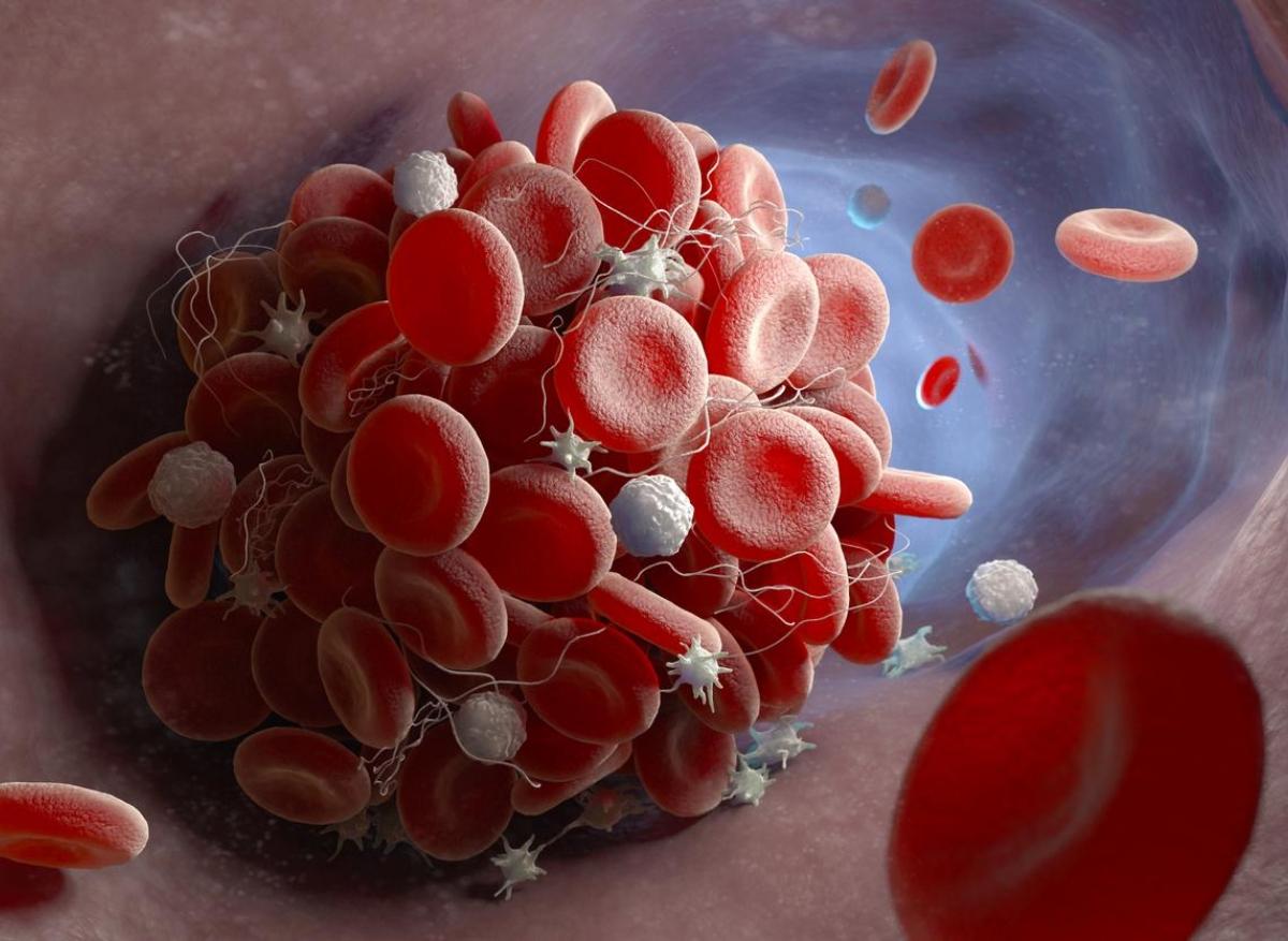 Covid-19 : un anticorps anti-phospholipide impliqué dans le risque de thrombose