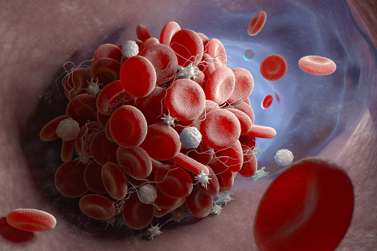 Thrombose sur cancer : 12 mois d’un anticoagulant oral direct font mieux que 3