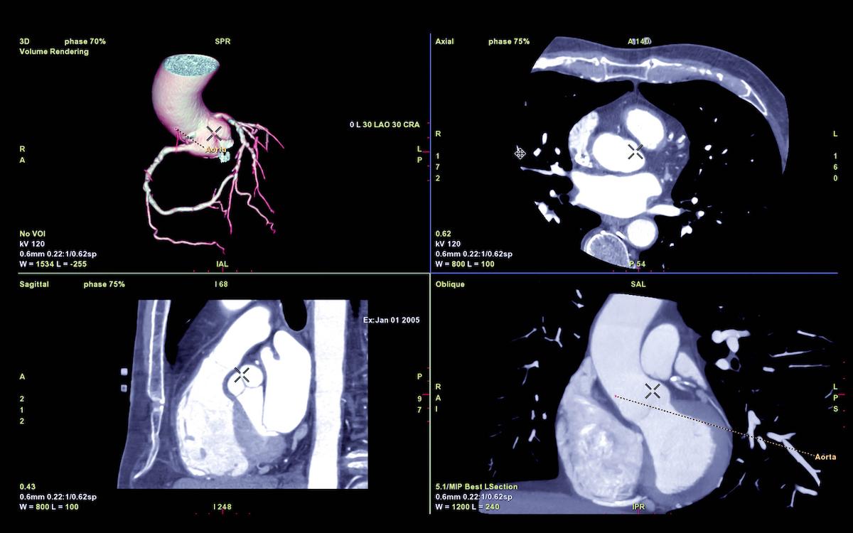 Score calcique et risque cardiovasculaire : plus performant que le score polygénique 