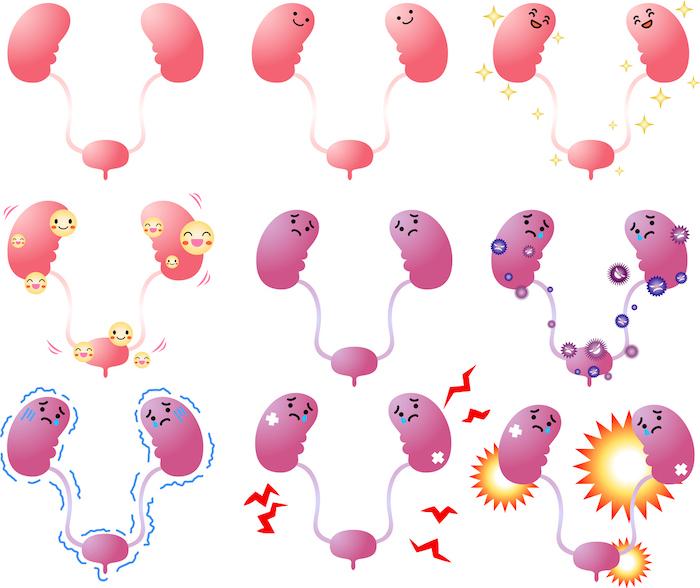 Syndrome néphrotique : l’allongement de la corticothérapie initiale pas nécessaire