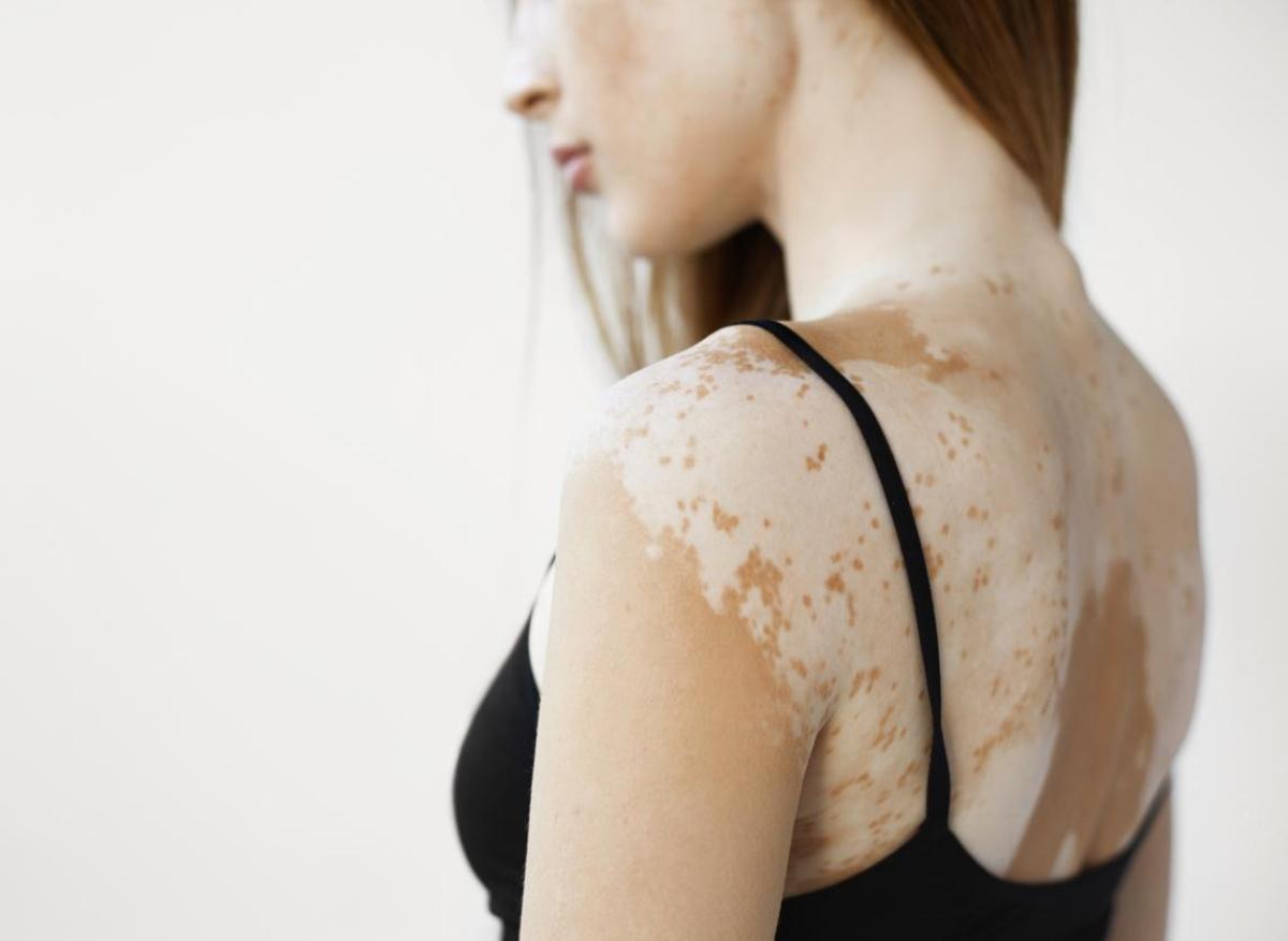 Vitiligo : le ruxolitinib bientôt disponible en traitement topique 