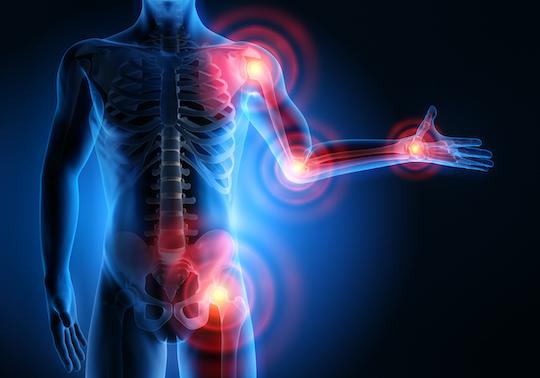 Covid-19 et rhumatismes inflammatoires : pas plus fréquente mais pronostic contrasté