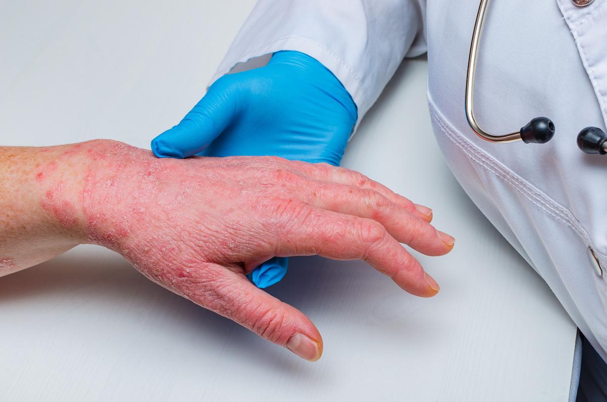 Dermatite atopique : efficacité rapide d'un anti-JAK par rapport à une biothérapie