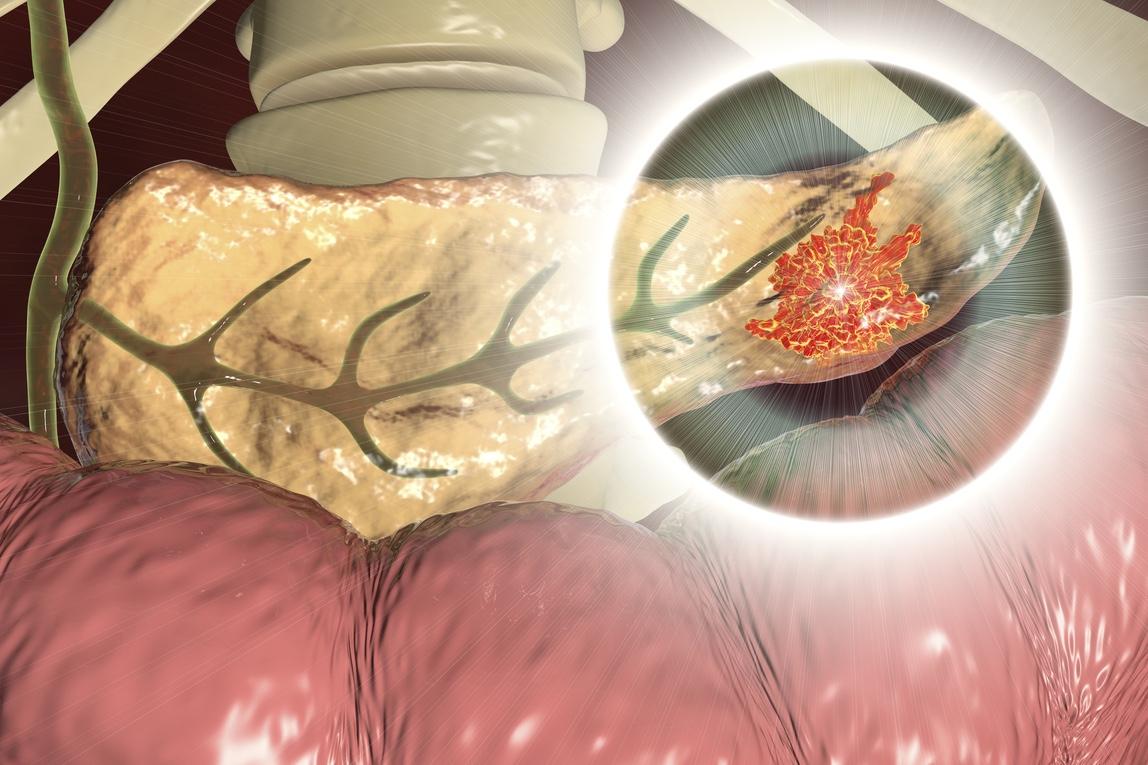 Cancer du pancréas localisé : FOLFIRINOX vs gemcitabine dans l'essai PREOPANC-2 