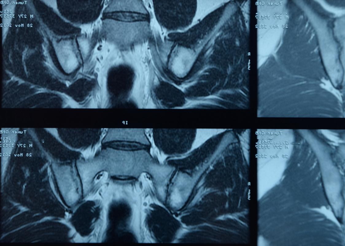 Spondylarthrite ankylosante : fréquence identique de la maladie dans les 2 sexes