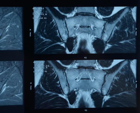 Spondylarthrite axiale : un anti-IL-17A améliore les formes non-radiologiques