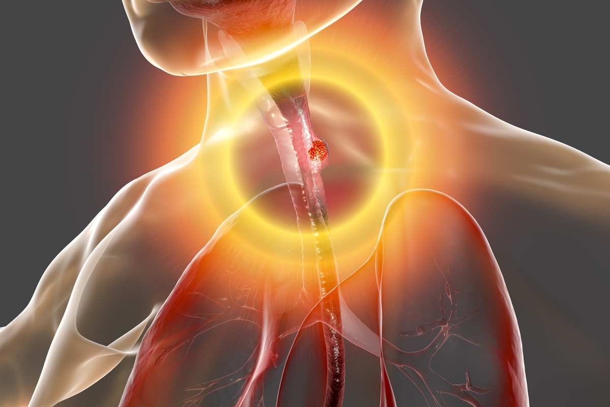 Cancer de l’œsophage : allonger le délai entre radiochimiothérapie pré-opératoire et la chirurgie ?