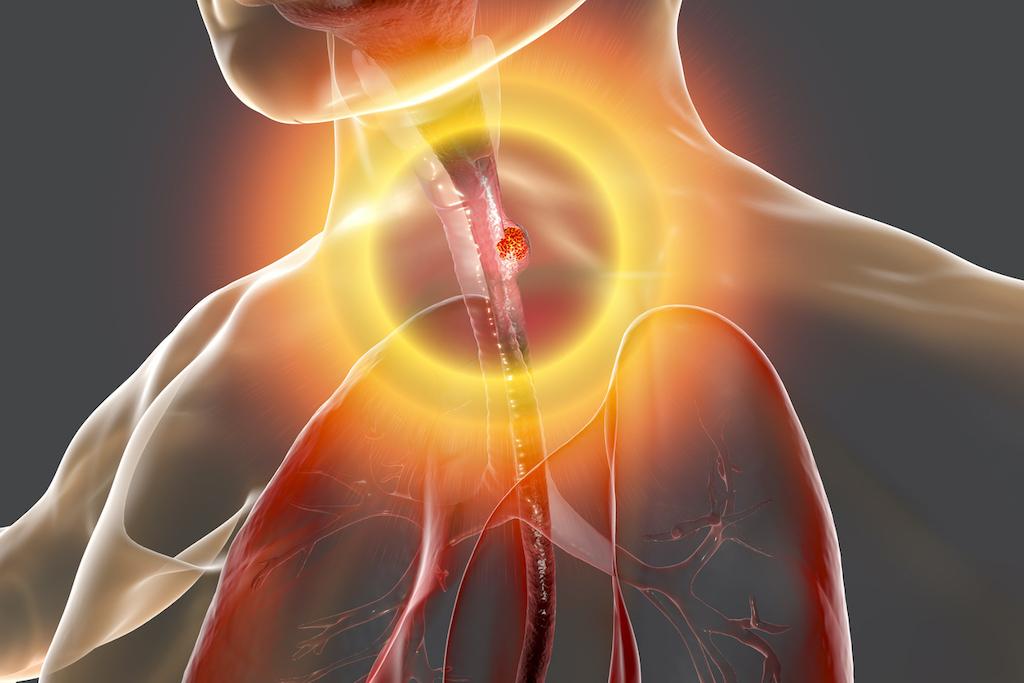 Cancers de l’oesophage : l’immunothérapie à tous les stades et à toutes les étapes de traitement 