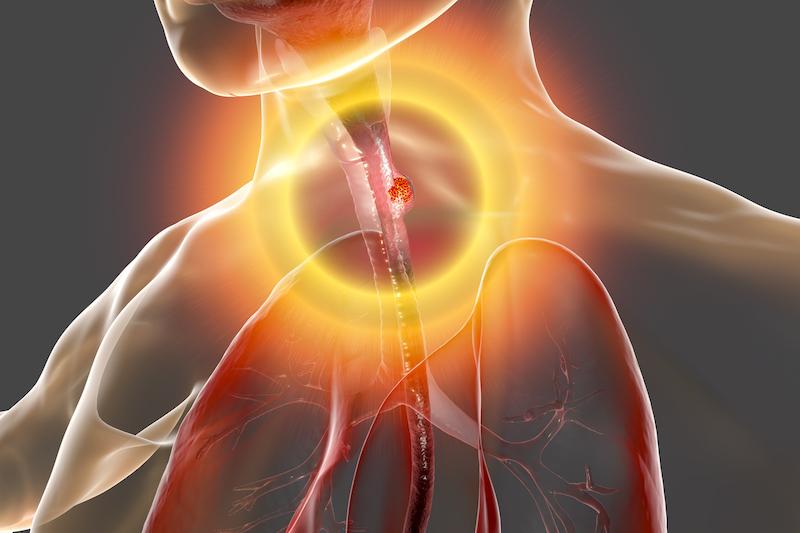 Endo-brachy-oesophage avec dysplasie de bas grade : efficacité limitée de la radiofréquence