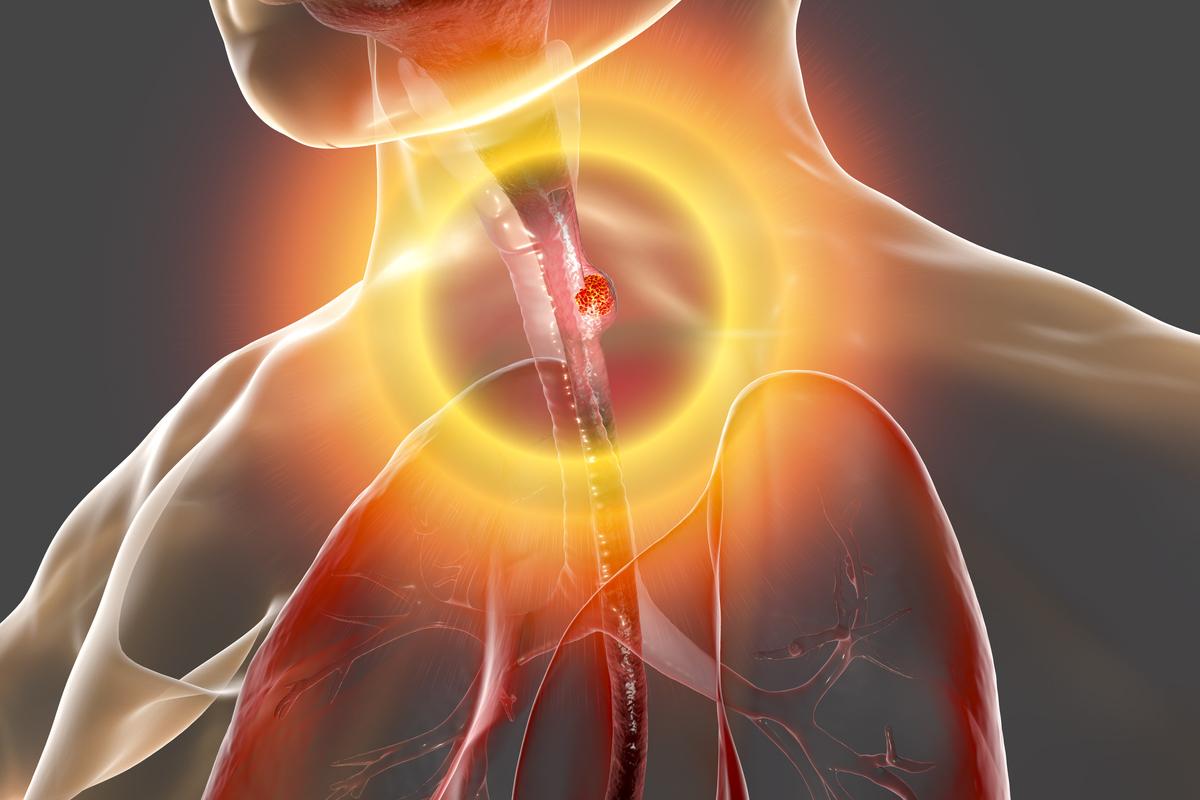 Cancers œsogastriques : la claudine18.2 en 1ère ligne