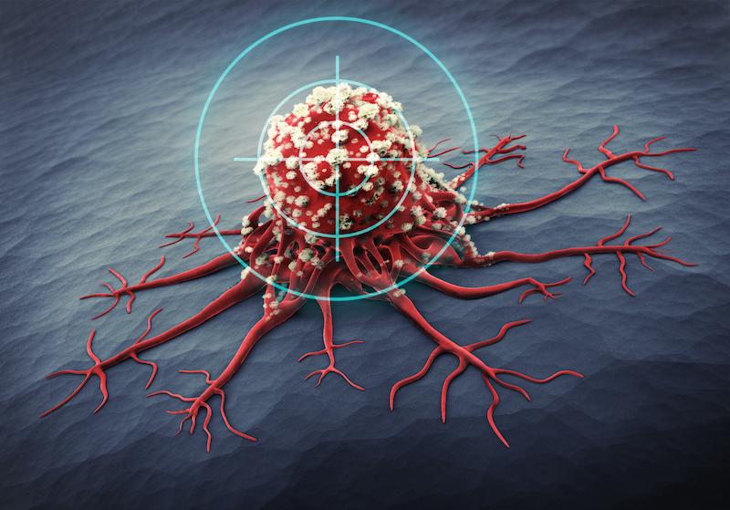 Mélanome avec métastases cérébrales : supériorité de l’association immunothérapie-radiothérapie