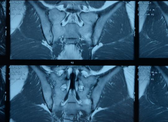 Spondylarthrite axiale : définition IRM consensuelle des lésions sacroiliaques