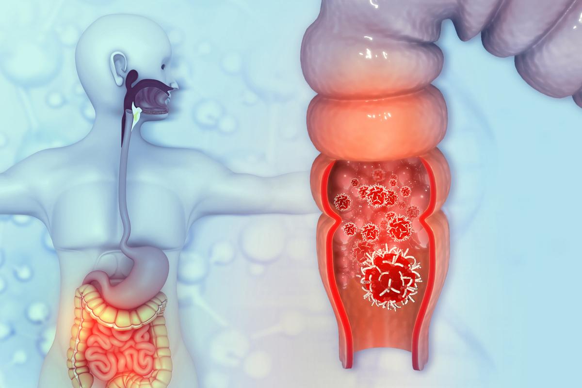 Adénocarcinome rectal : remplacer la chimioradiothérapie néoadjuvante par la chimiothérapie ?