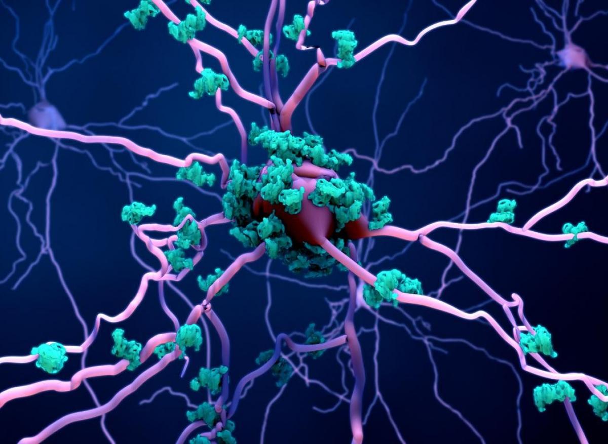 Alzheimer : le cholestérol impliqué dans la production de plaques bêta-amyloïdes