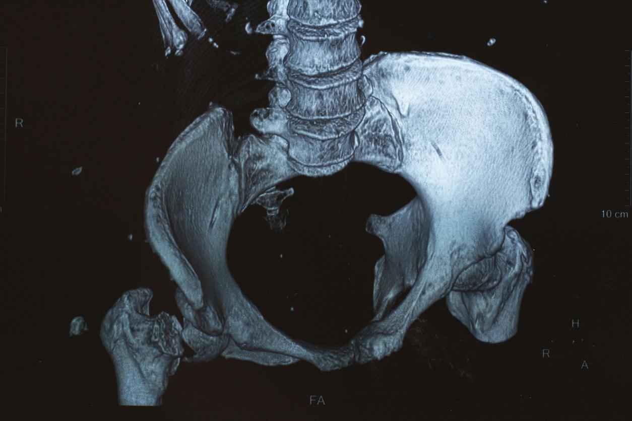 Myélome multiple : amélioration de la survie sans progression avec l’ixazomib en entretien