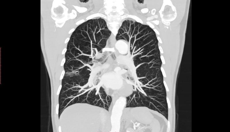 Adénocarcinome du pancréas : TEP FAPI une imagerie moléculaire du stroma tumoral