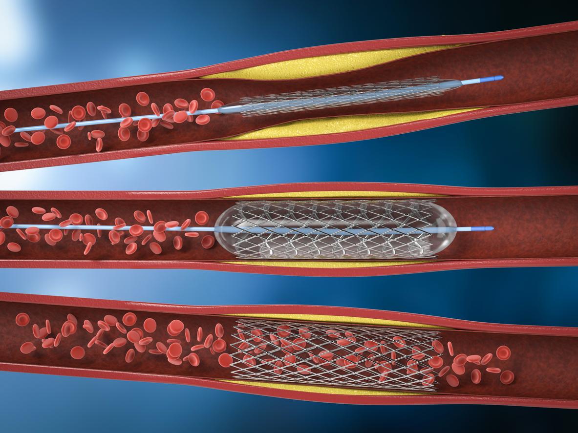 Resténose coronaire intra-stent : intérêt des ballonnets enduits de paclitaxel 