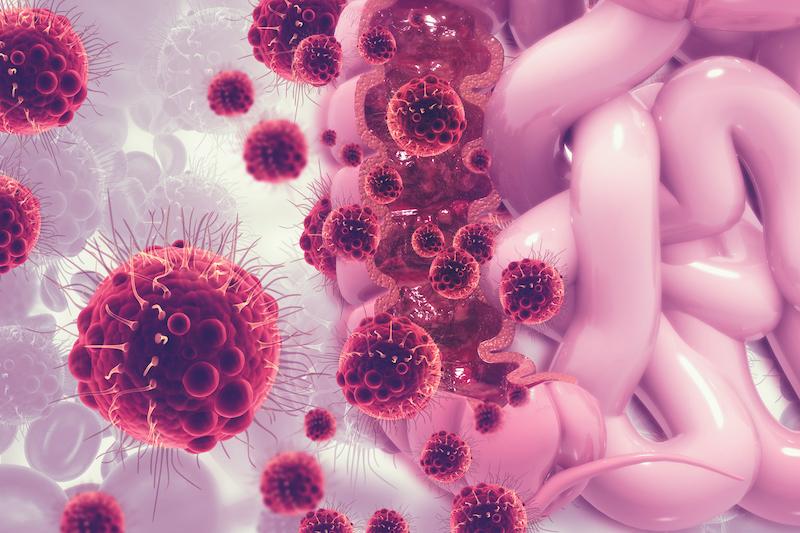 Cancer colorectal MSS : l’efficacité de l’immunothérapie dépend de la charge mutationnelle
