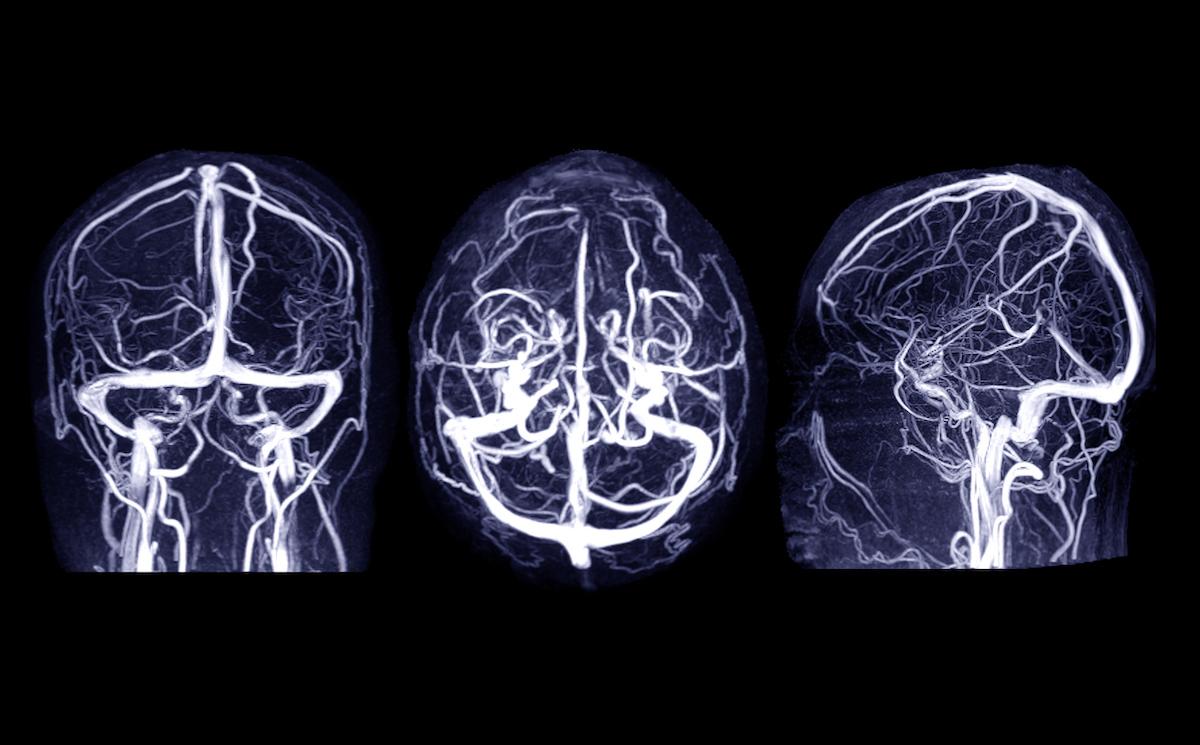 AVC ischémique : faut-il faire baisser la pression artérielle à la phase aiguë ?