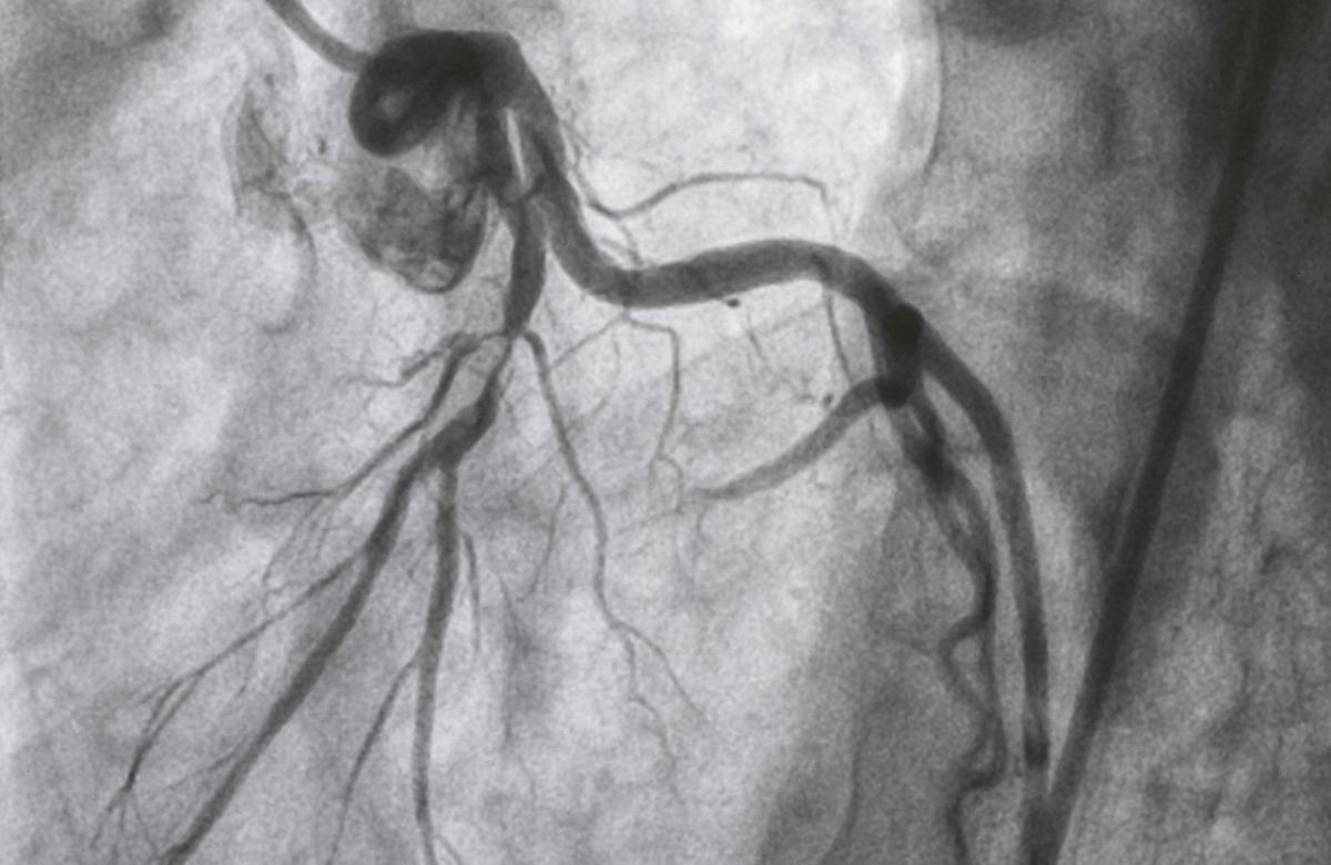 DAPT après angioplastie : chez les patients à haut risque hémorragique, un mois suffit