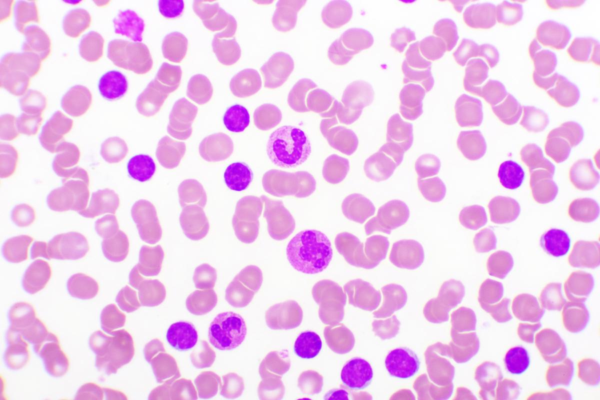 Leucémie lymphocytaire chronique à haut risque : efficacité d’un triplet AVO