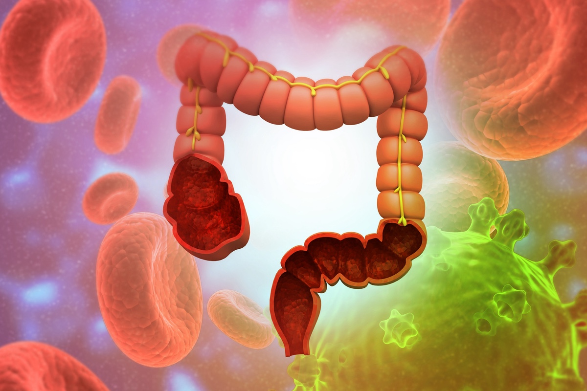 Cancer du rectum : radiothérapie courte, immuno-chimiothérapie, l’UNION fait la force