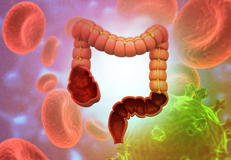 Cancer du canal anal en rechute et/ou métastatique : résultats décevants pour l’Immunothérapie 