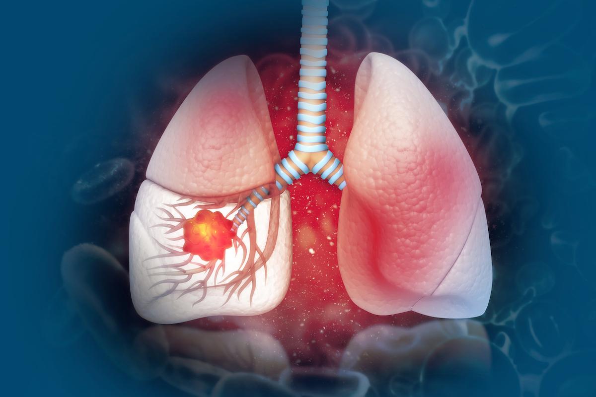 Cancer Bronchique NPC métastatique : lutter contre le phénomène d'hyper-progression initiale sous immunothérapie