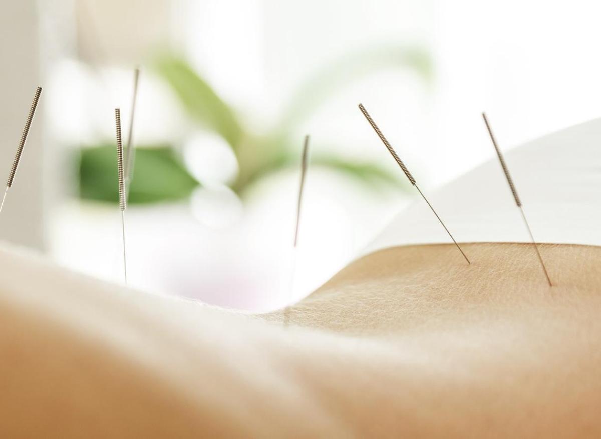 Aphasie post-AVC : l'acupuncture pourrait réduire les formes motrices