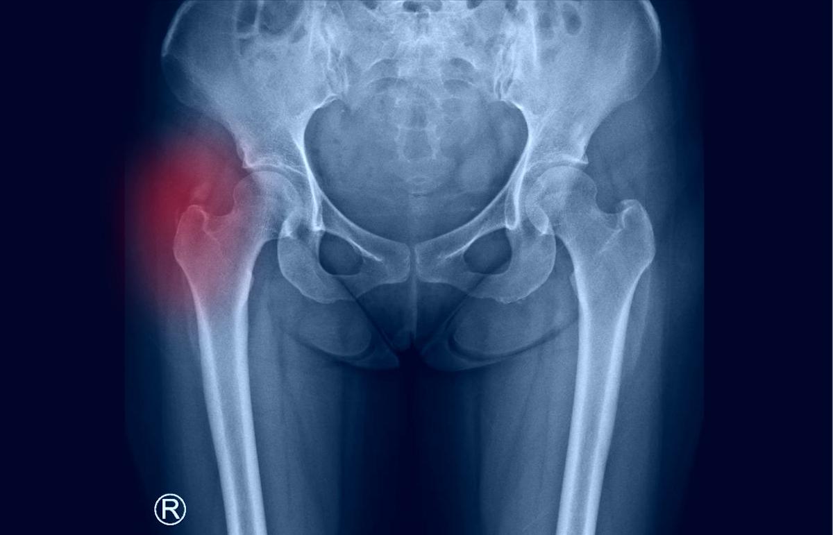 Partage Médical - CASÉUM Amas de matières calcifiées au