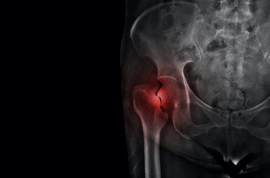 Fracture de hanche : le bénéfice des bisphosphonates validé à grande échelle