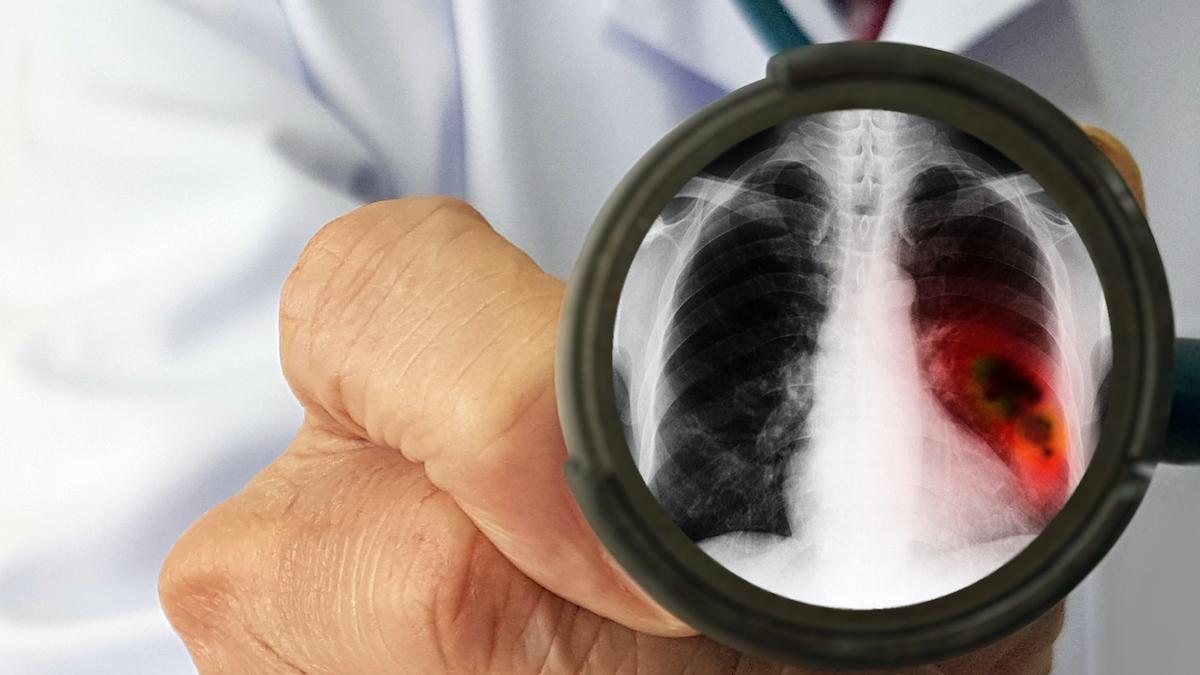 Cancer du poumon NPC KRAS G12C muté : une nouvelle thérapie ciblée