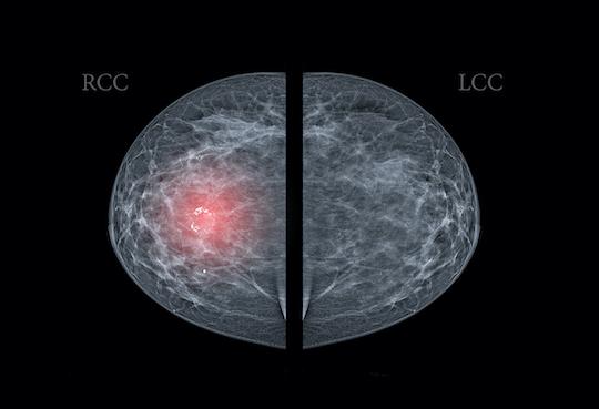 Cancer du sein HER2+ : une nouvelle molécule change la donne en cas de métastases cérébrales 