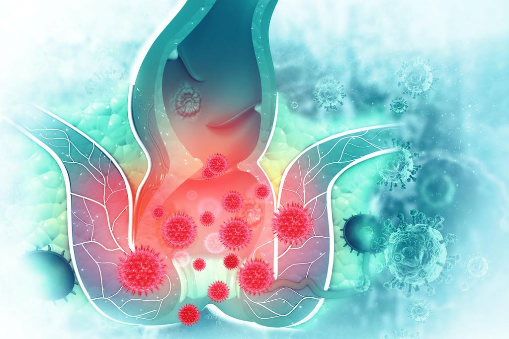 Cancer du rectum : choix de la méthode de préservation rectale 