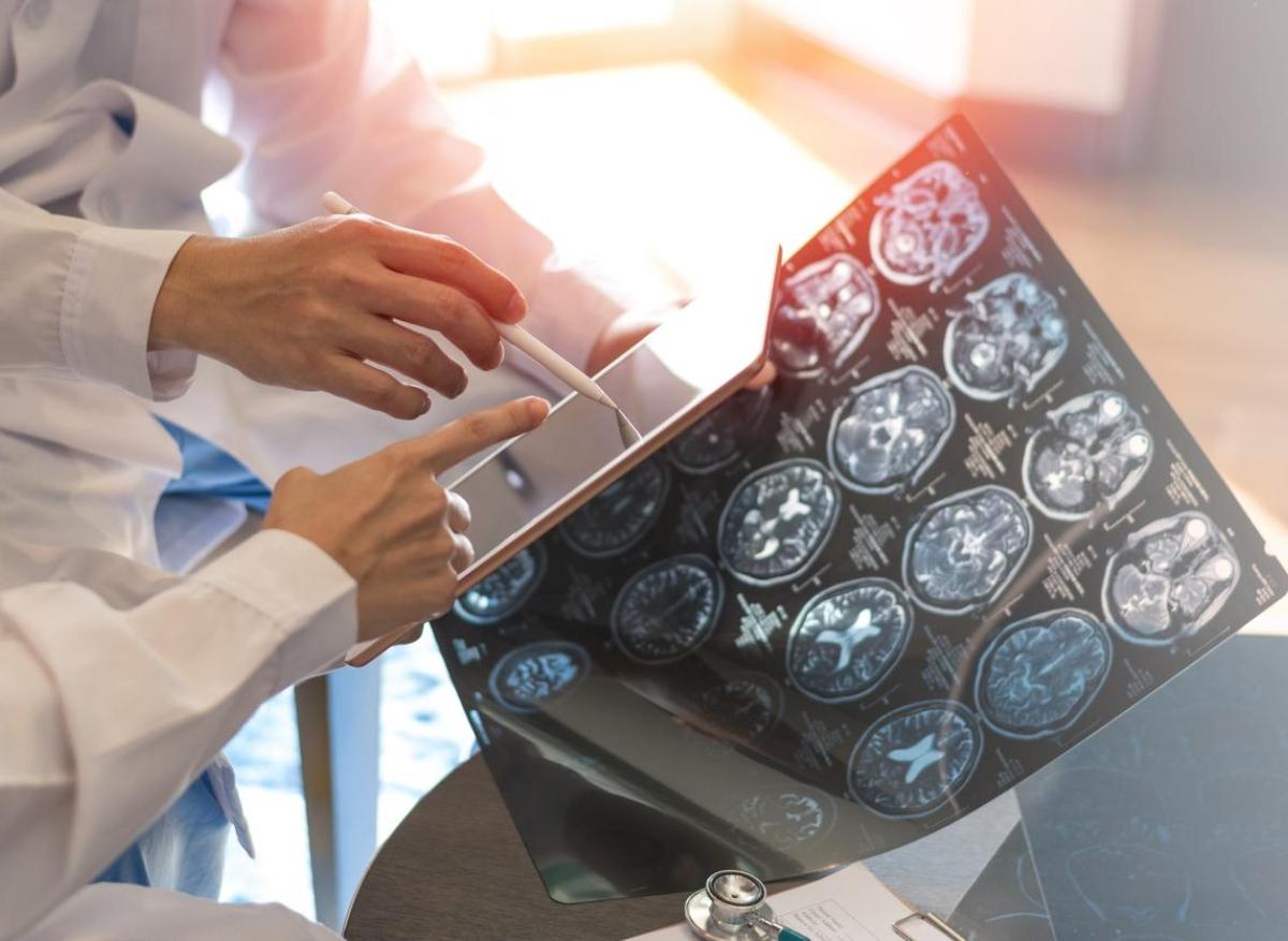 Migraine : l'IRM haute résolution objective des modifications du cerveau