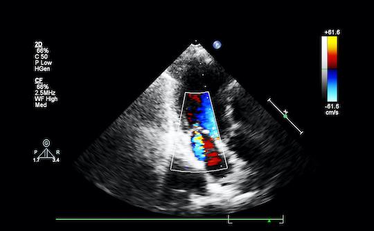 Rétrécissement aortique serré : la voie percutanée efficace mais améliorable
