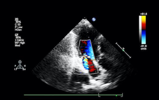 Valve aortique : la thrombose de valve infraclinique est un phénomène dynamique 