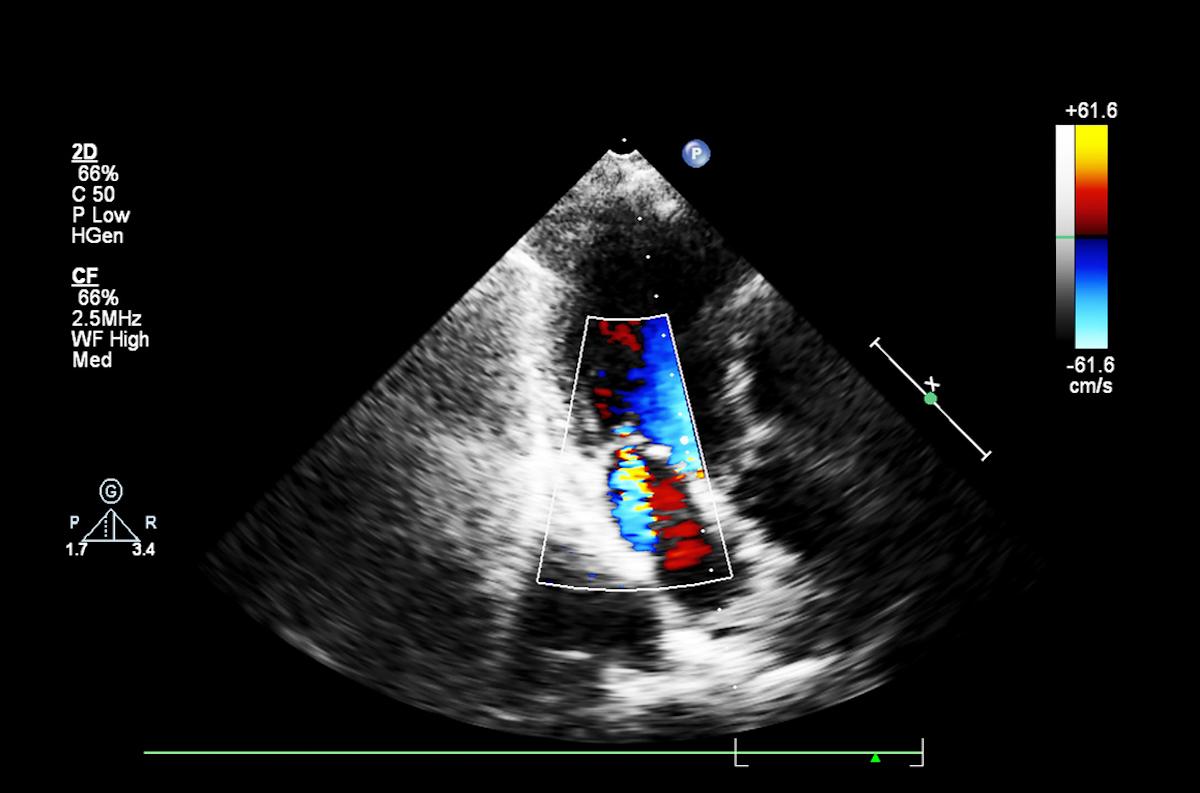 Valvulopathie rhumatismale et FA : les AVK largement supérieurs au rivaroxaban