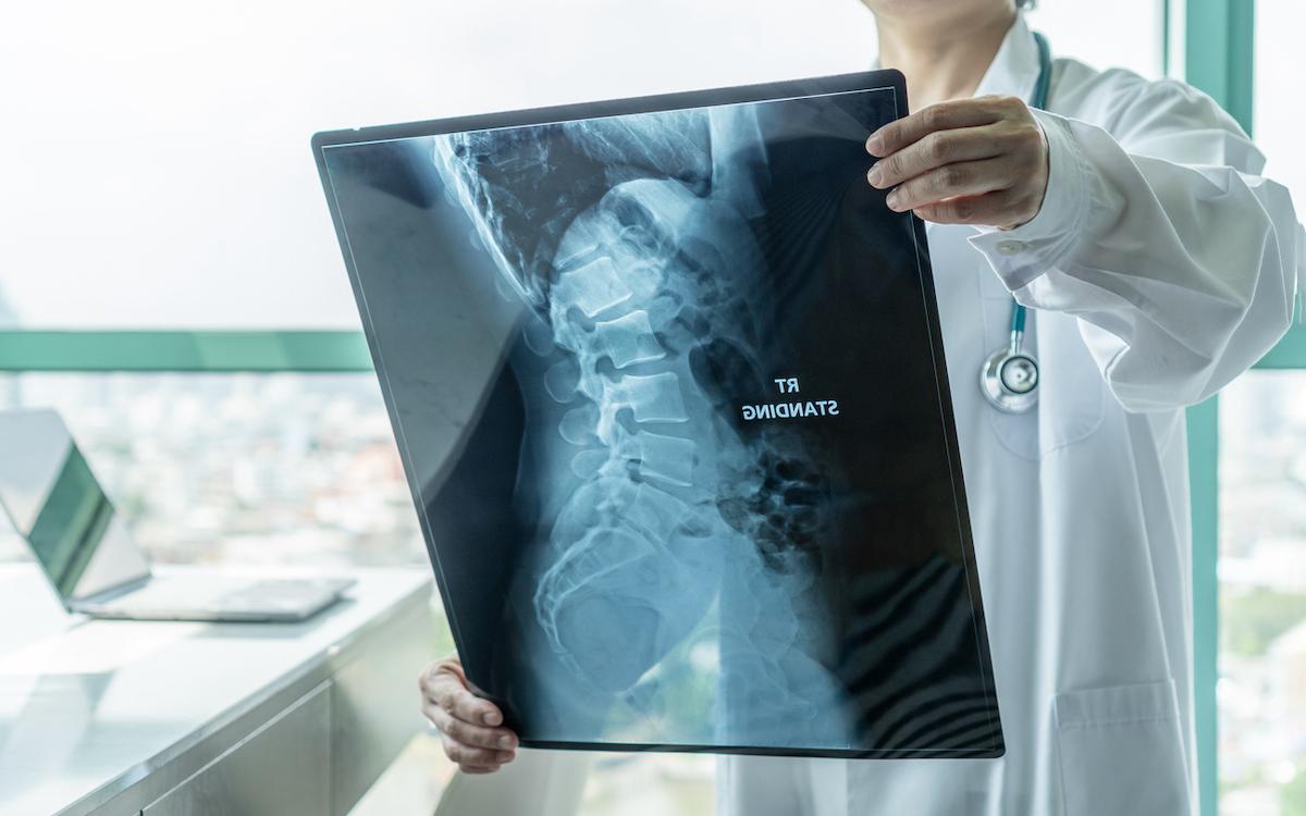 Spondylarthrite : l’effet structural des anti-TNF serait retardé de 2 ans